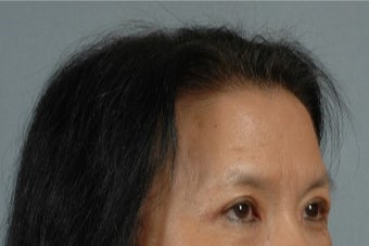 45-54 year old woman treated with Asian Eyelid Surgery after 3615945