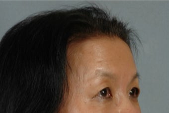 45-54 year old woman treated with Asian Eyelid Surgery before 3615945