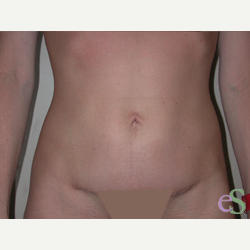 41 year old woman treated with Tummy Tuck after 3484822