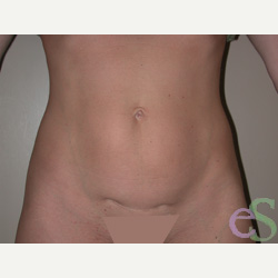 41 year old woman treated with Tummy Tuck before 3484822