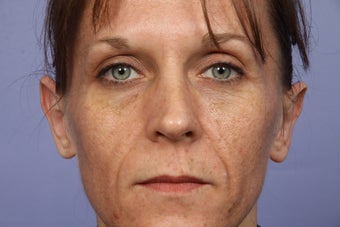 40 yr old Otoplasty after 1013677