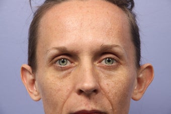 40 yr old Otoplasty before 1013677