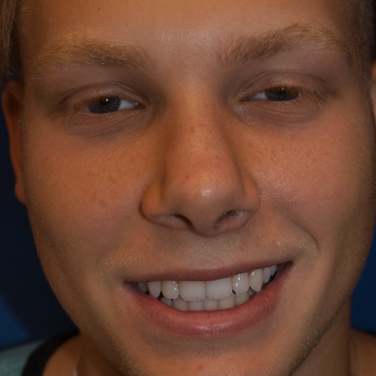 18-24 year old man treated with Rhinoplasty after 3326299