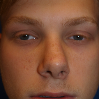 18-24 year old man treated with Rhinoplasty before 3326299