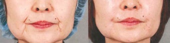 Facial Correction with filler before 1123910