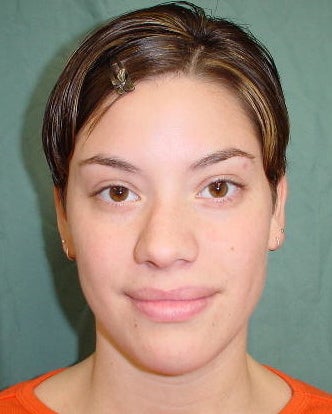 Septorhinoplasty before 756137