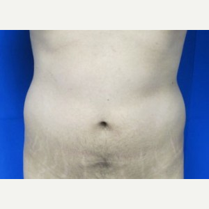 Liposuction before 3094166