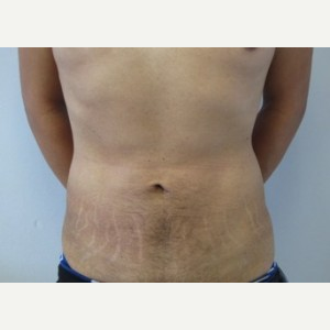 Liposuction after 3094166