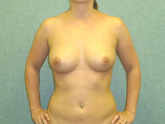 Fat transfer to the Breast - Natural Breast Augmentation after 435201