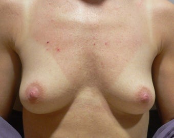 Breast Augmenation before 943673