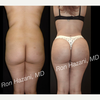18-24 year old woman treated with Brazilian Butt Lift before 3680275