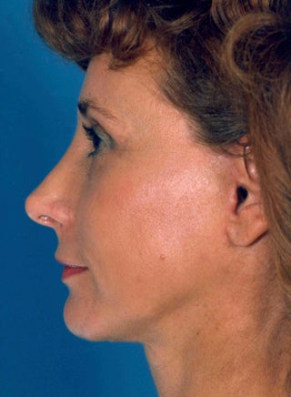 Facelift 1047989