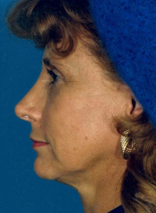 Facelift 1047989
