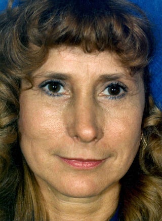 Facelift before 1047989