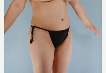 45-54 year old woman treated with Tummy Tuck after 2358652