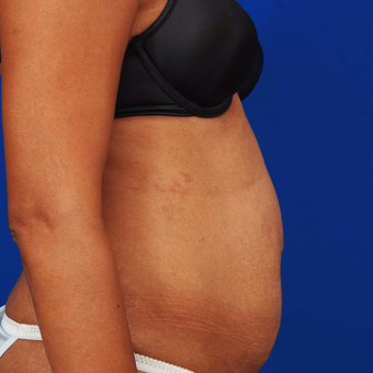 Mother of Two Treated with Abdominoplasty and Liposuction before 3165517