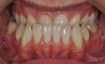 Maxillary Advancement and Canine Substitution before 952619