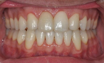 Maxillary Advancement and Canine Substitution after 952619