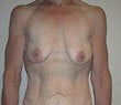 48 year old female patient before 925553