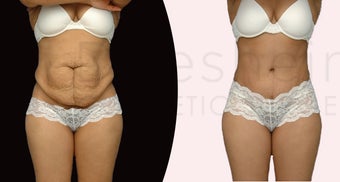 36 yr old woman before and 1 year after Mommy Makeover before 1141704