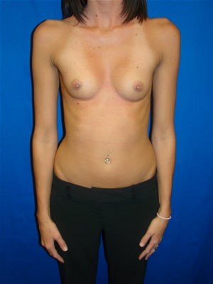 Breast Augmentation Surgery before 130970