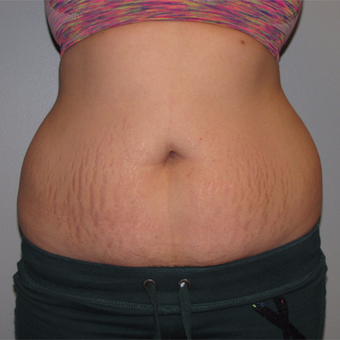 18-24 year old woman treated with Tummy Tuck before 3130506