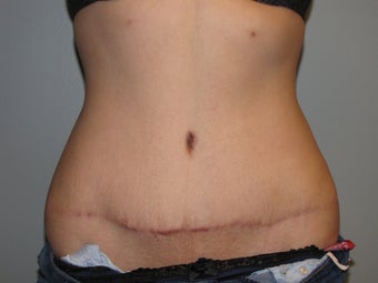 18-24 year old woman treated with Tummy Tuck after 3130506