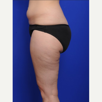 25-34 year old woman treated with Liposuction before 3200495