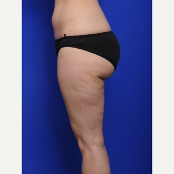 25-34 year old woman treated with Liposuction after 3200495