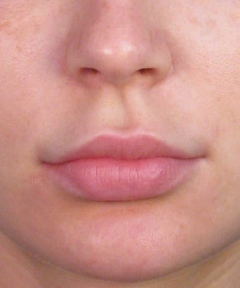 Upper Lip Lift Surgery Using Subnasale Technique before 1155089