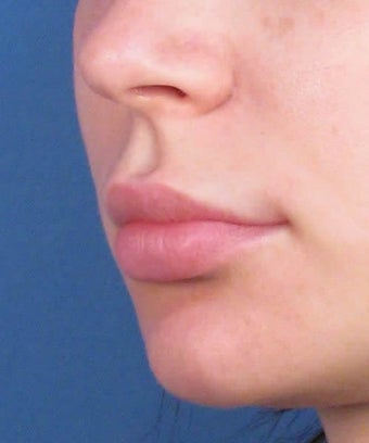 Upper Lip Lift Surgery Using Subnasale Technique 1155089