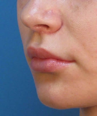 Upper Lip Lift Surgery Using Subnasale Technique 1155089