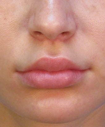 Upper Lip Lift Surgery Using Subnasale Technique after 1155089