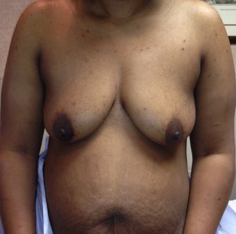 Immediate Bilateral DIEP Flaps before 1362792