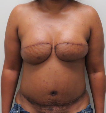 Immediate Bilateral DIEP Flaps after 1362792