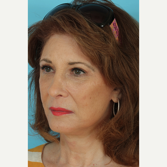 55-64 year old woman treated with Facelift after 3691347