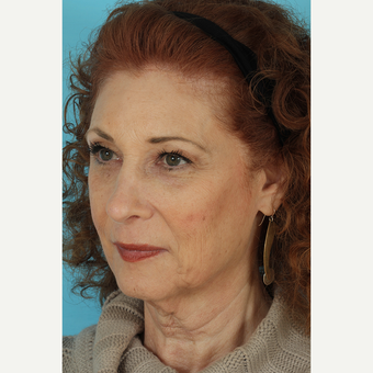 55-64 year old woman treated with Facelift before 3691347