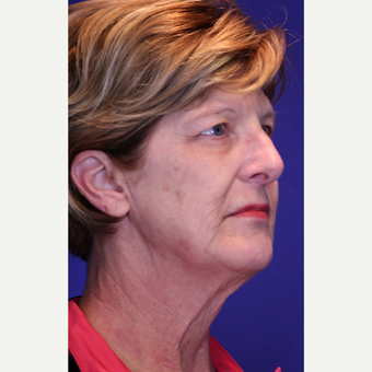 Facelift, Fractional CO2 Laser Skin Resurfacing before 3466423