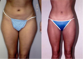 22-year-old woman treated with Liposuction. before 574533