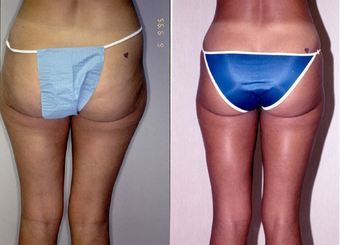 22-year-old woman treated with Liposuction. after 574533