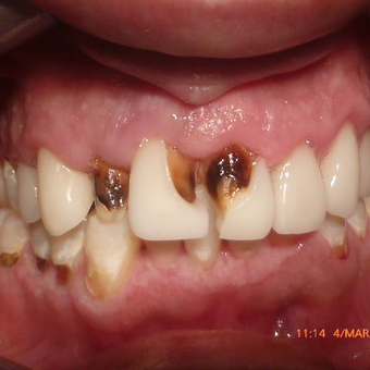 Smile Makeover - CERAC CROWNS - Instant digital dentistry before 3136498