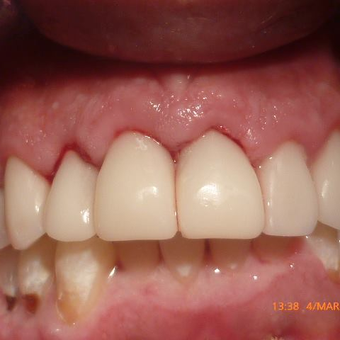 Smile Makeover - CERAC CROWNS - Instant digital dentistry after 3136498