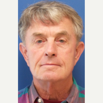 65-74 year old man treated with Facelift before 3246326