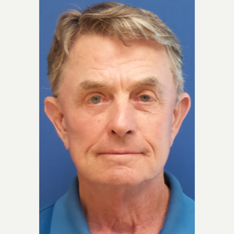 65-74 year old man treated with Facelift after 3246326