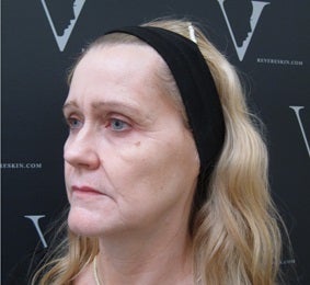 Juvederm fillers to soften fine lines and redefine facial contours before 3298325