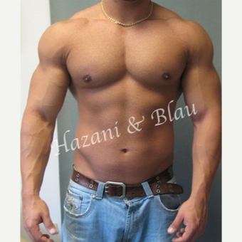 25-34 year old man treated with Male Breast Reduction after 3321332