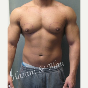 25-34 year old man treated with Male Breast Reduction before 3321332