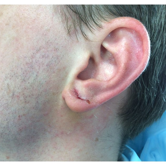 25-34 year old man treated with Ear Lobe Surgery after 3187439