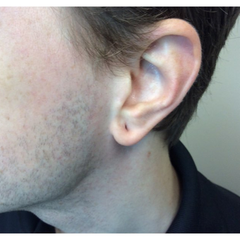 25-34 year old man treated with Ear Lobe Surgery before 3187439