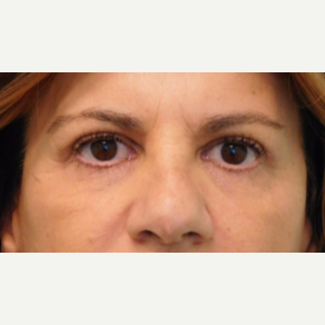 45-54 year old woman treated with Brow Lift and Upper Eyelid Lift after 3749128